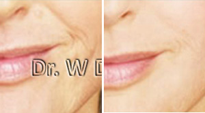 Juvederm Before After