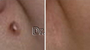 Mole Removal Before After 01