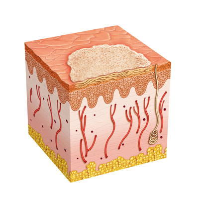 Basal Cell Carcinoma