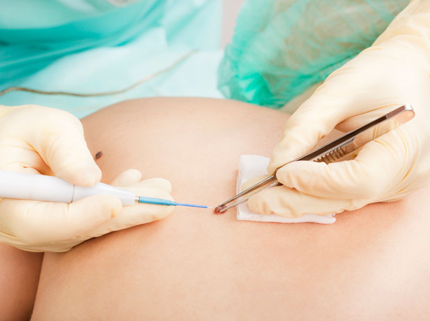 Mole removal method