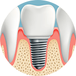 Dental implant