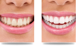 Before After Teeth Whitening Case 01