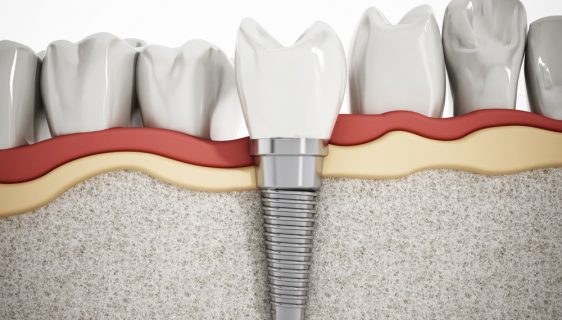Restorative Dentistry Quincy MA