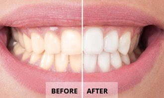  Before After