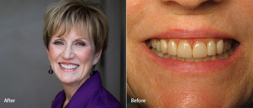 Before After 11