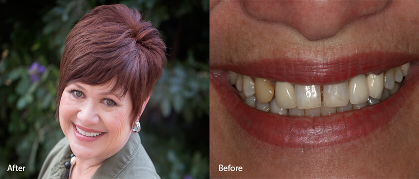 Before After 12