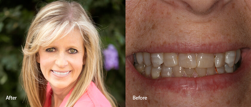 Before After 13