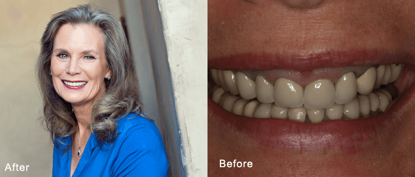 Before After 02