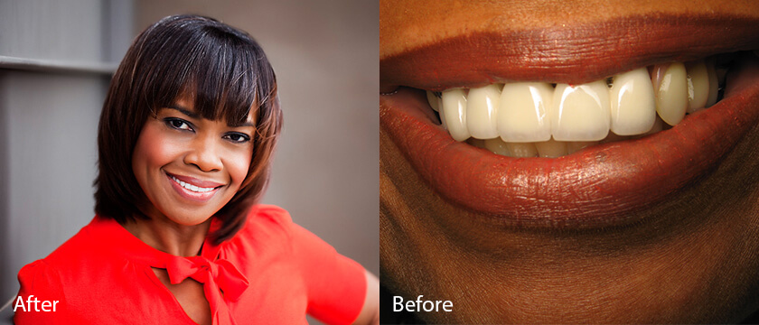 Before After 07