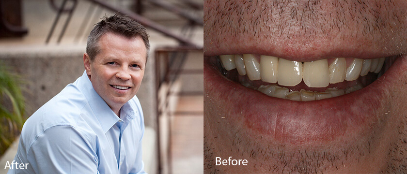 Before After 04