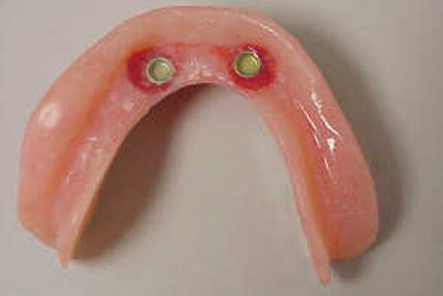 Implant After 07