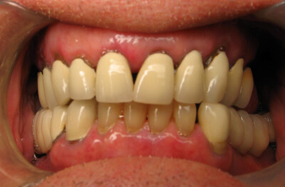 Hybrid Denture Before