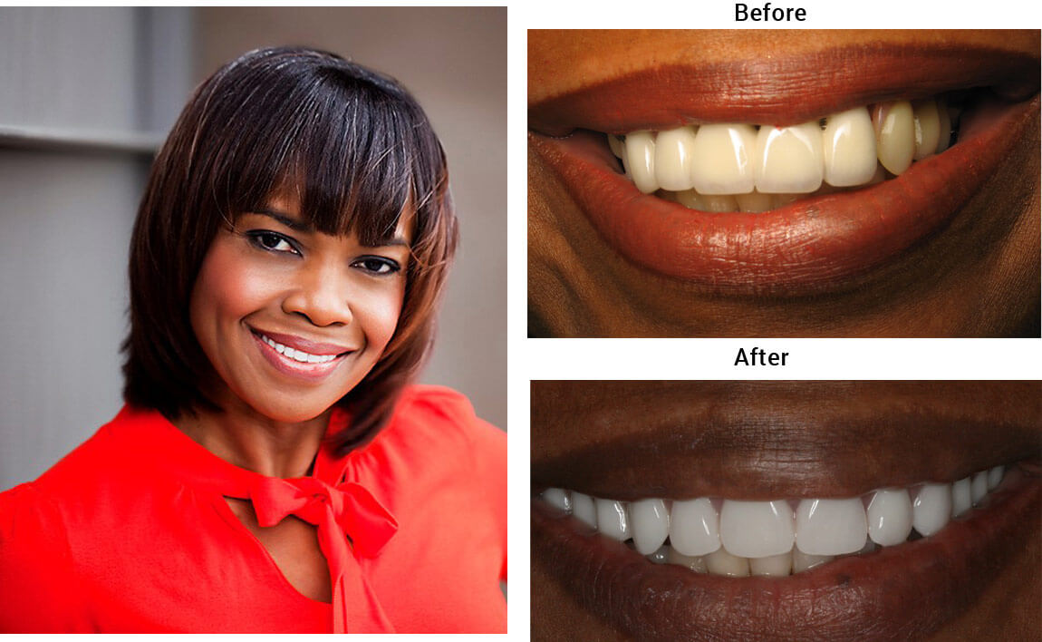 Hybrid Denture Before After 02