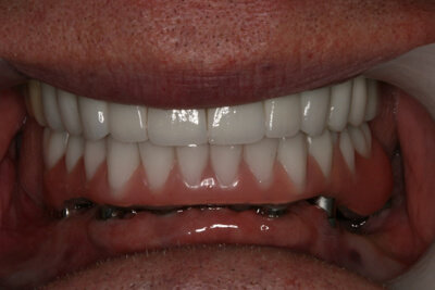 Hybrid Denture After 01