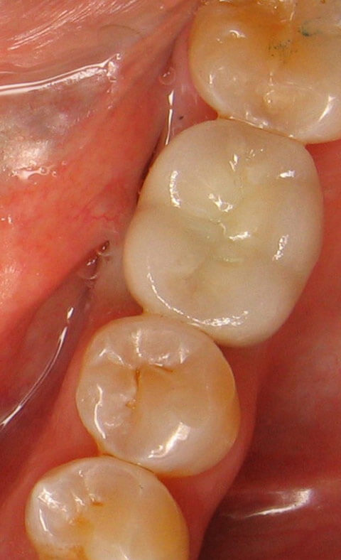 Implant After 04