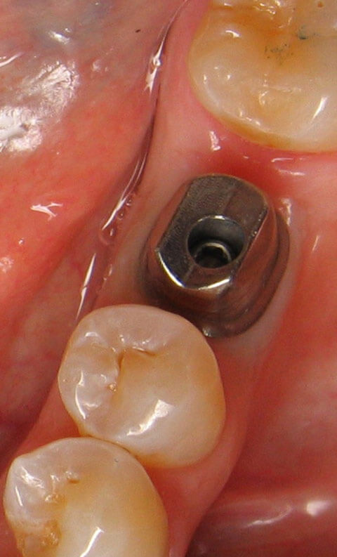 Implant Before 04