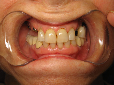 Implant Before 05