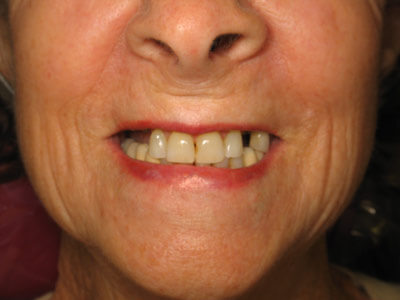 Implant Before 06