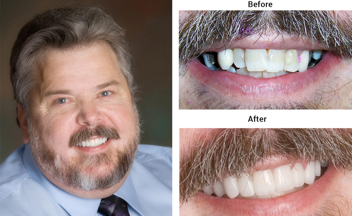 Implant Before After 06