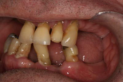 Implant Before 07