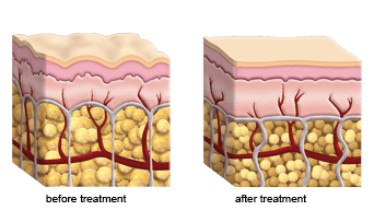 <?php echo $pk;?> - Cellulite Reduction Before After