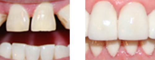 Before after Porcelain Veneers and Crowns