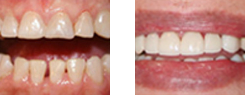 Before after  Crowns and Laminates