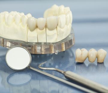 Dental Crowns and Bridges from Richmond VA Dentist