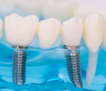 Dental Implants from Richmond VA Dentist