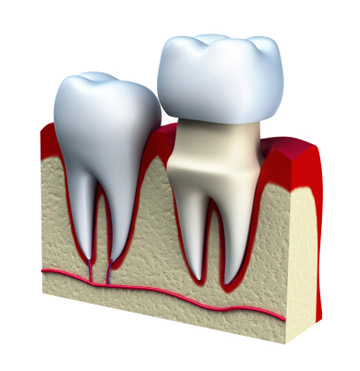 Dental Crown Illustration