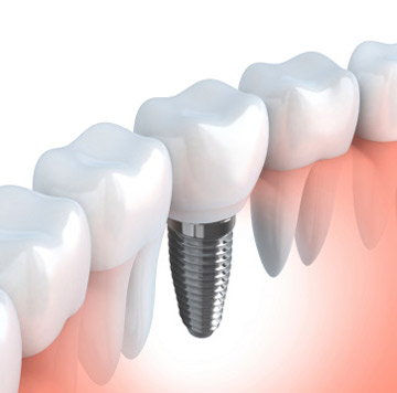 Dental Implant Illustration