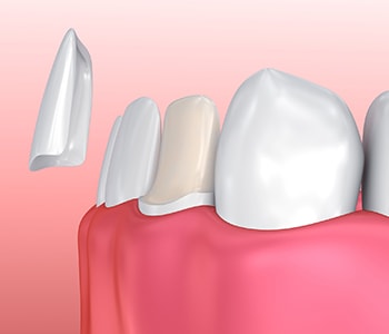 Customized Dental Crown Sacramento