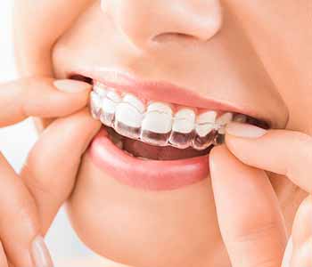 Dr. Azouz Darry in Sacramento Natural Dentistry gives tips on caring for invisible braces for patients Sacramento, CA