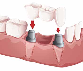 Dental crown treatment has many functional, restorative, and cosmetic uses. Call Dr. Darryl Azouz in Citrus Heights,