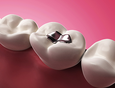 Mercury Safe Dentistry