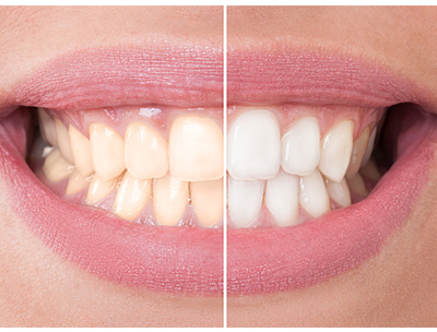 Teeth Whitening