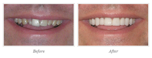 Esthetic Gum Surgery 01
