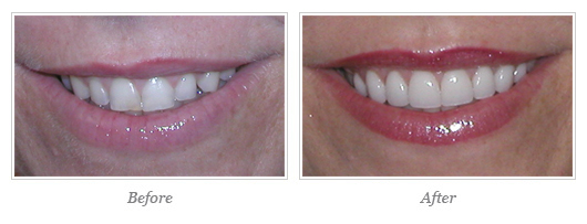 Esthetic Gum Surgery 02