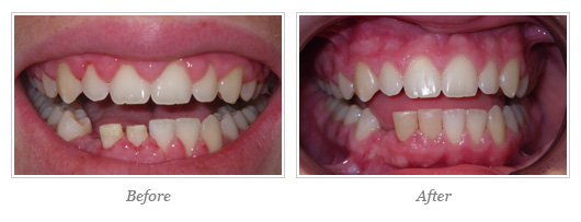 Esthetic Gum Surgery 03