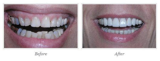 Invisalign Before After 01
