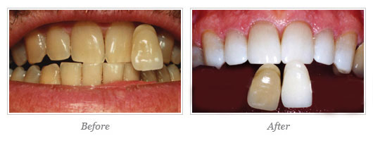 Kor Whitening Before After 01