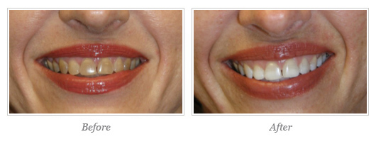 Kor Whitening Before After 11