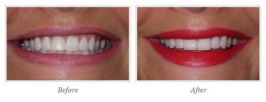Kor Whitening Before After 12