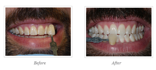 Kor Whitening Before After 14