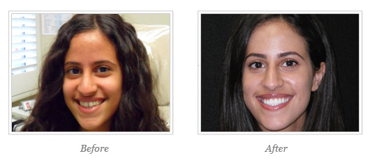 Kor Whitening Before After 15