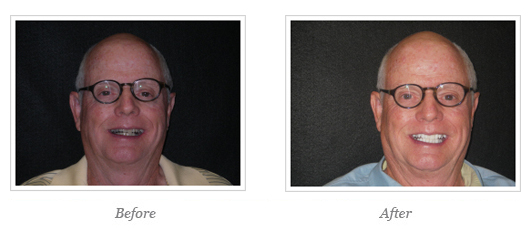 Kor Whitening Before After 16