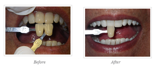 Kor Whitening Before After 17