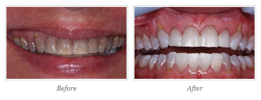 Kor Whitening Before After 02
