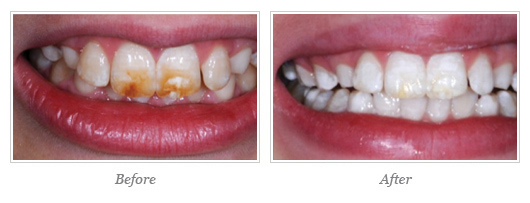 Kor Whitening Before After 04