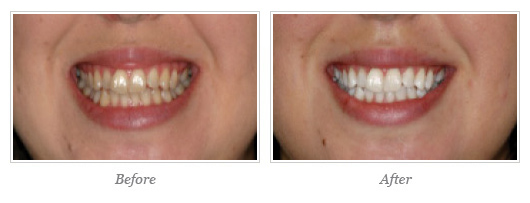 Kor Whitening Before After 07